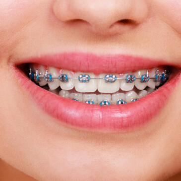 Rovnátka mohou zkomplikovat ústní hygienu, jak na ni?